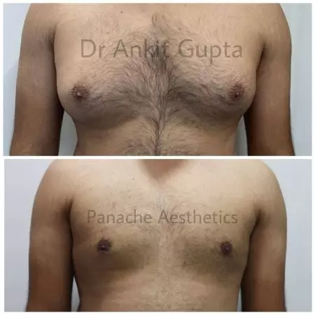 Gynecomastia Surgery before and after result 3 — Dr. Ankit Gupta, Panache Aesthetics Delhi